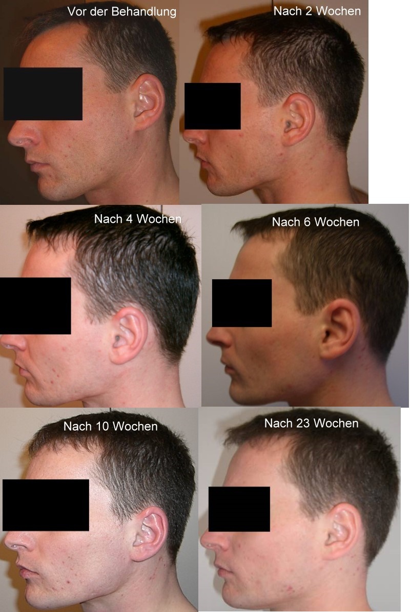 Isotretinoin Bilddoku Akne Org Forum Pickel Mitesser Akne Therapien
